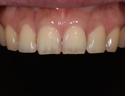 Tooth Extraction
